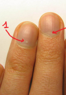 Почему на ногтях появляются белые пятна: основные причины заболевания