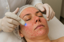 Лечение демодекоза: как приручить невидимого клеща и вернуть коже спокойствие