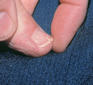 Слоятся ногти на ногах: основные причины