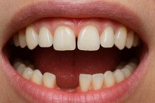 Когда и как удалять зуб: понятный гид без паники