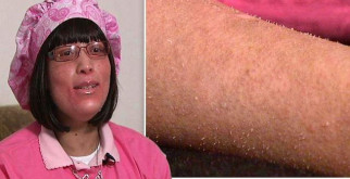 Страшная мутация: ногти вместо волос