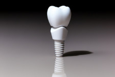 Основы имплантации зубов: что нужно знать перед визитом к врачу