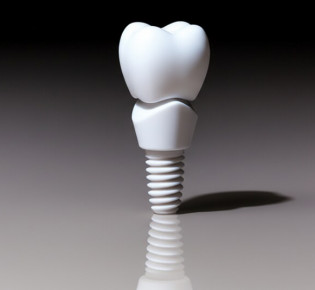 Основы имплантации зубов: что нужно знать перед визитом к врачу