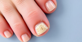 Nagelpilz erkennen und effektiv behandeln: guía clara y práctica para recuperar tus uñas