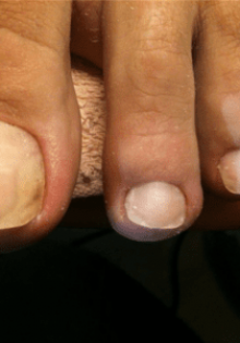 С чего начинается лечение запущенной формы грибка ногтя
