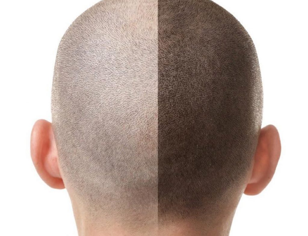 Трихопигментация: что это и как лечится?